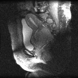 U xơ tử cung ở cổ tử cung (Leiomyoma of the uterine cervix)