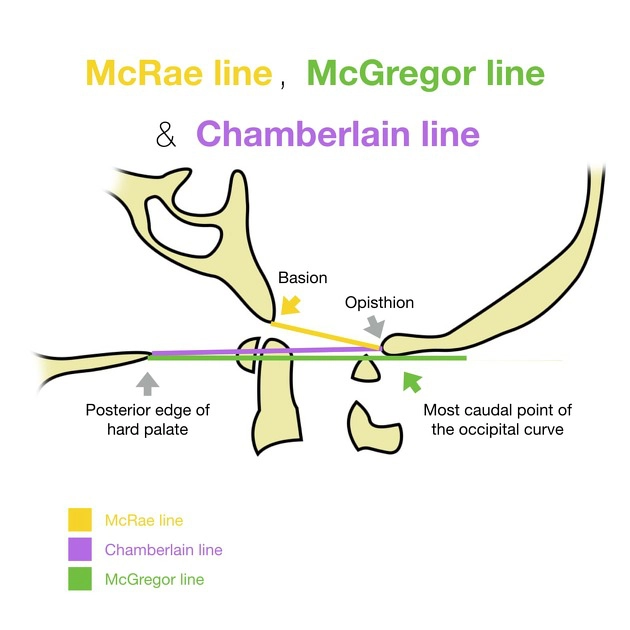 Thoát vị hạnh nhân tiểu não (Tonsillar Herniation)