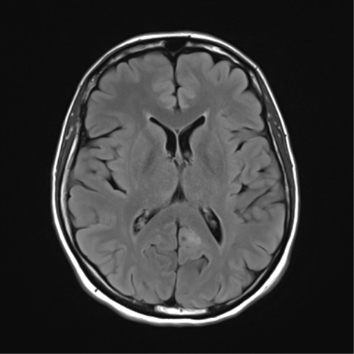 Bệnh lý mạch máu não do xạ trị (Radiation-induced cerebral vasculopathy - RICV)