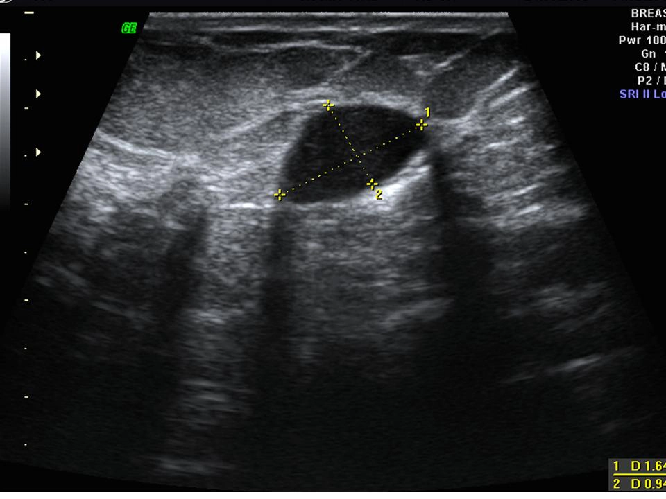 Đặc điểm hình ảnh siêu âm tuyến vú  (Benign and malignant characteristics of breast lesions at ultrasound)