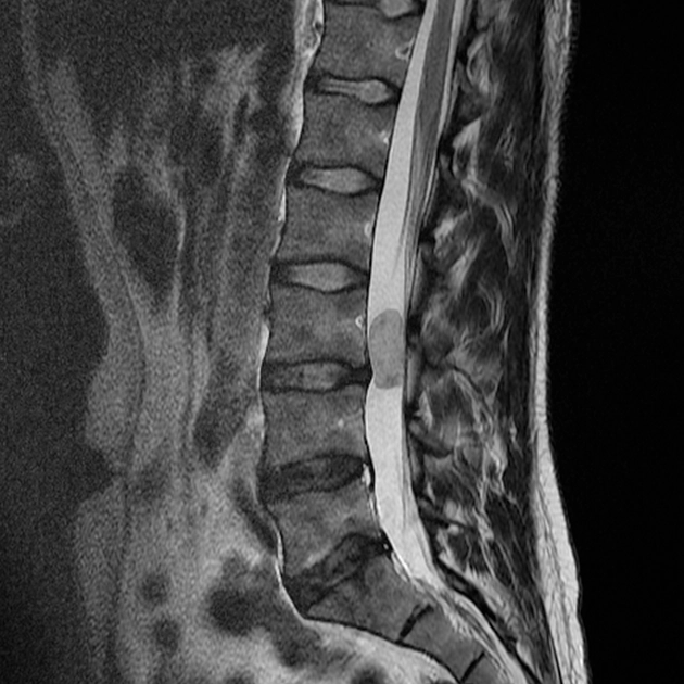 U vùng chóp tủy (Neoplasms of the cauda equina)