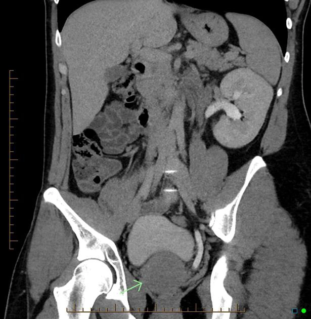 Nang túi tinh (Seminal vesicle cyst)