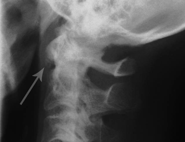 Xương phụ cung trước đốt đội (Accessory ossicle of the anterior arch of the atlas)