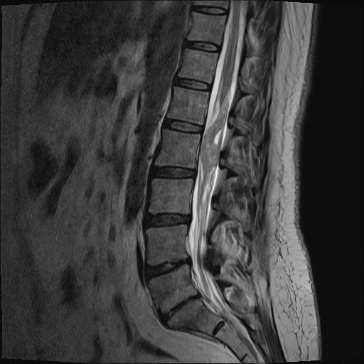 Lymphoma tủy sống (Lymphoma of the spinal cord)