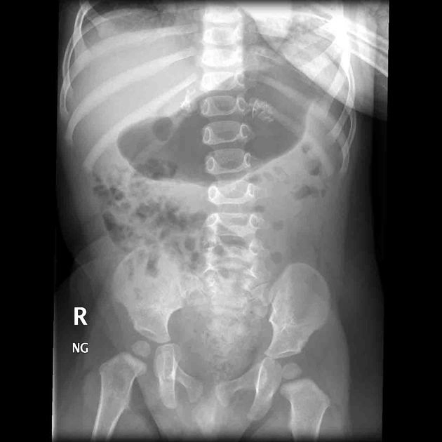 Vôi hóa tuyến thượng thận (Adrenal calcification)