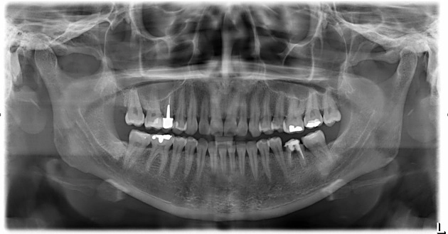 Xơ cứng xương hàm dưới vô căn (Idiopathic osteosclerosis of the mandible)