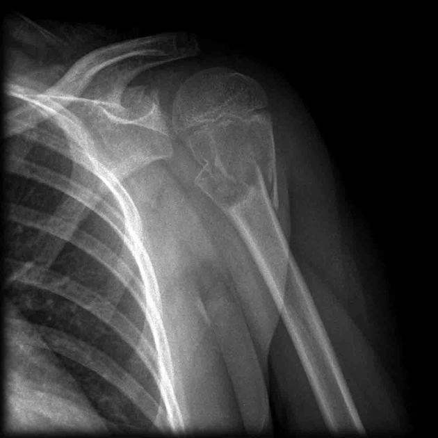 Nang xương đơn giản (Simple Bone Cyst - SBC)