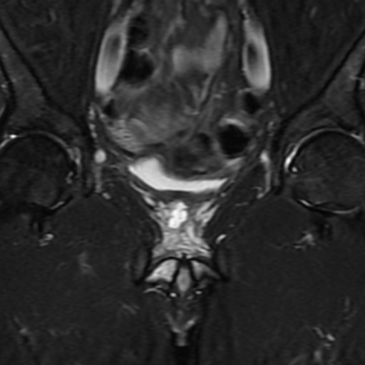 Áp xe tuyến tiền liệt (Prostatic abscess)