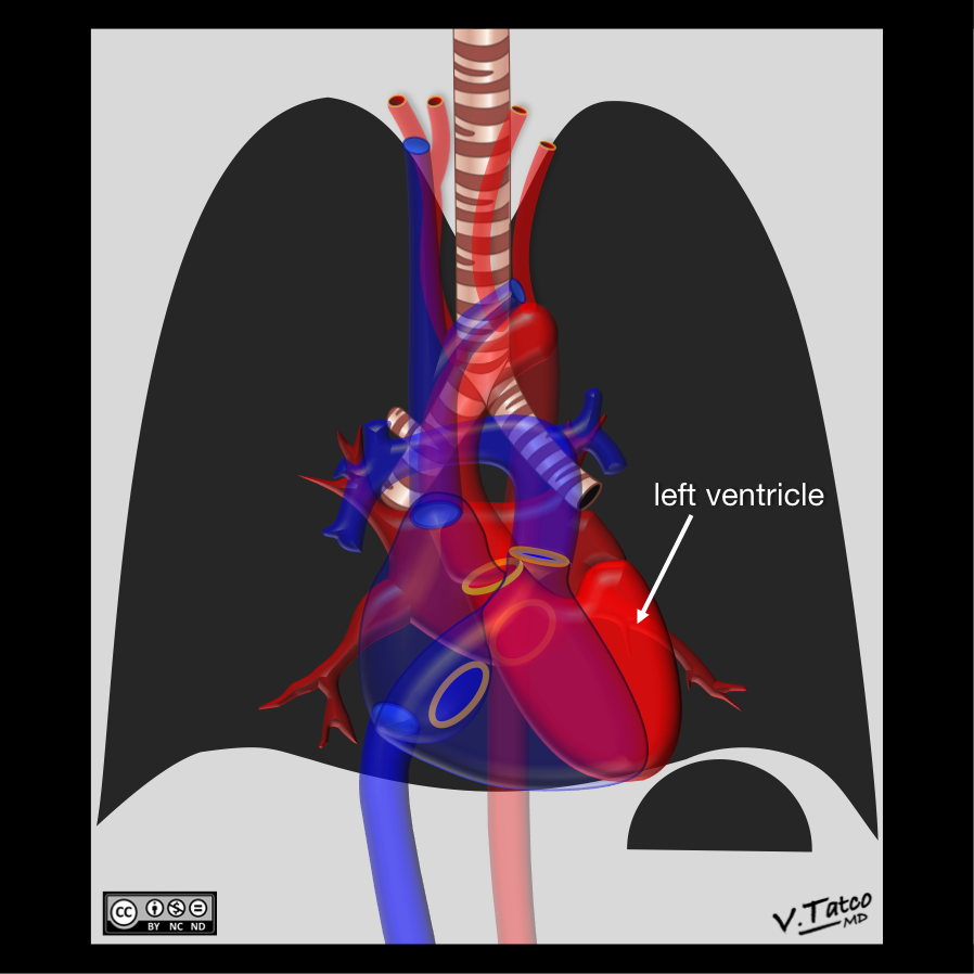 Giãn buồng tâm thất trái (Left Ventricular Enlargement - LVE)