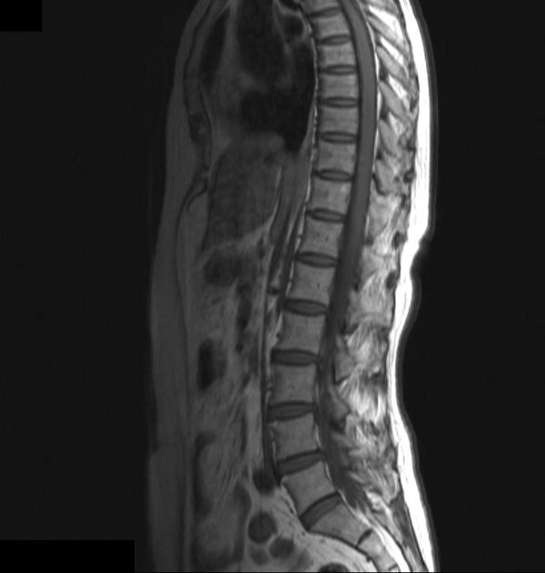 Dị dạng mạch máu cột sống (Spinal vascular malformations)