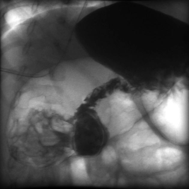 Màng ngăn tá tràng (Duodenal web/intraluminal duodenal diverticulum)