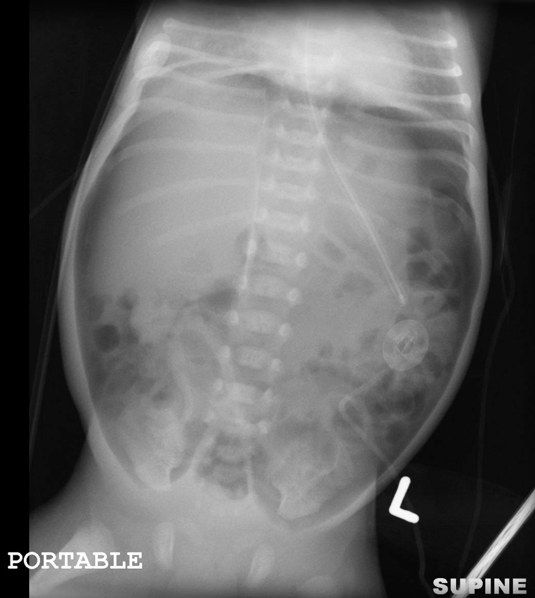 Dấu hiệu bóng đá (tràn khí phúc mạc) - Football sign (pneumoperitoneum)