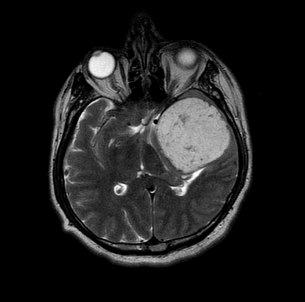 Chondrosarcoma nền sọ (Chondrosarcoma of the skull base)