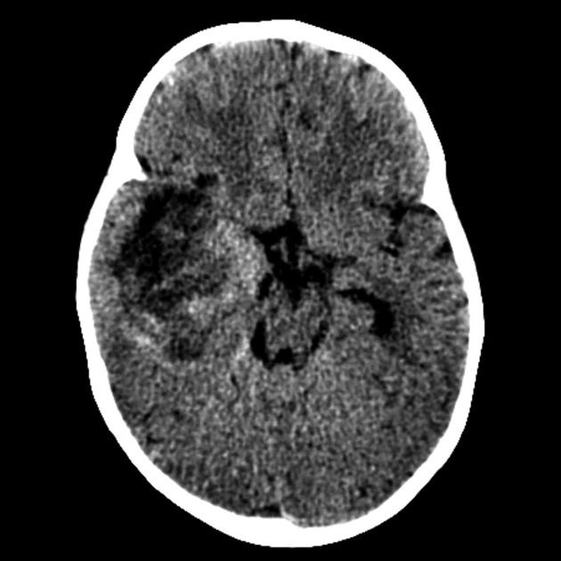 U quái/u cơ vân dạng không điển hình (Atypical teratoid/rhabdoid tumor - AT/RT)