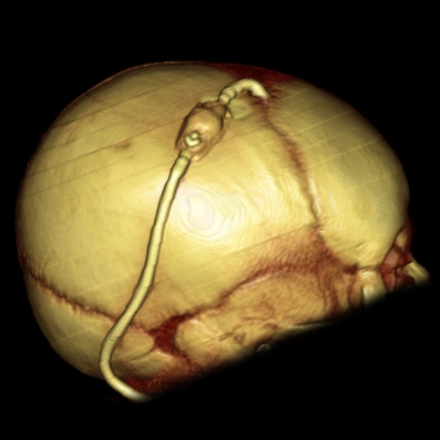 Dẫn lưu não thất-phúc mạc (Ventriculoperitoneal Shunt - VP) 
