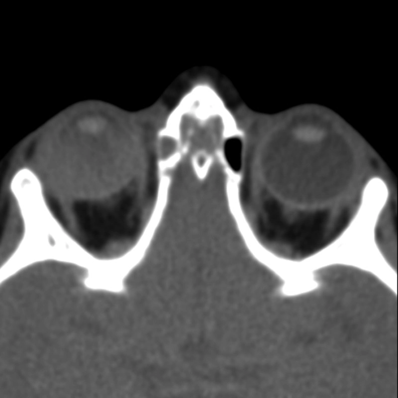 Viêm võng mạc xuất tiết (Exudative retinitis)
