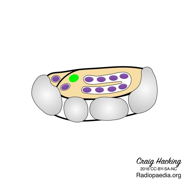Hội chứng ống cổ tay (Carpal tunnel syndrome)