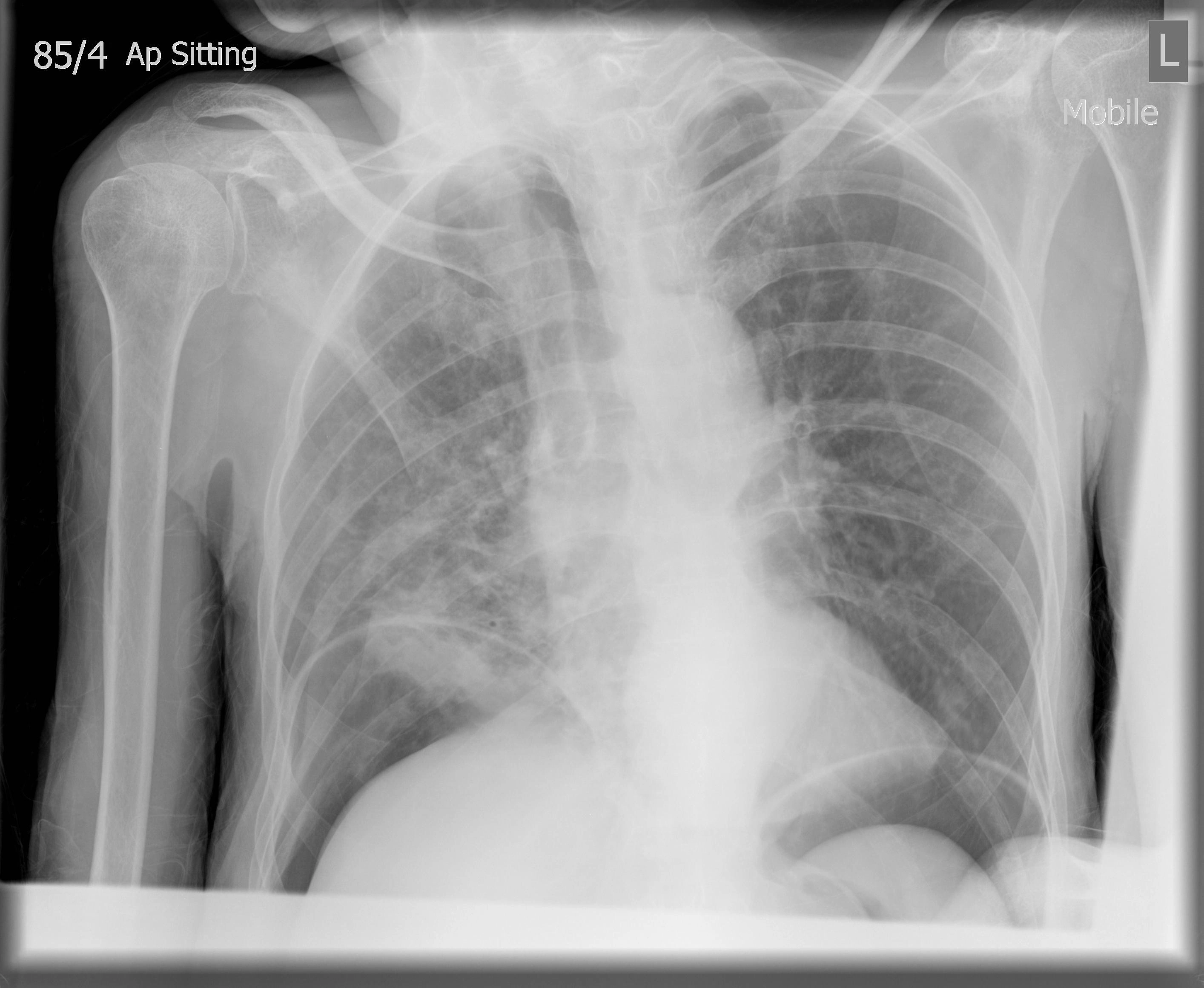 Tràn khí phúc mạc (Pneumoperitoneum)