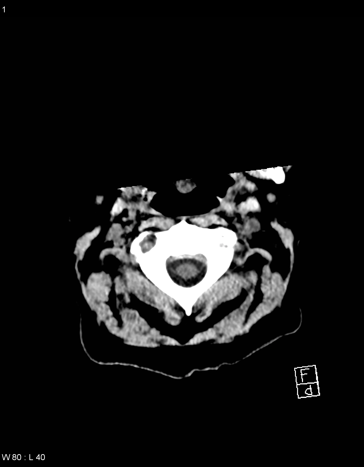 Đa u tủy nền sọ (Skull Base Multiple Myeloma - MM)