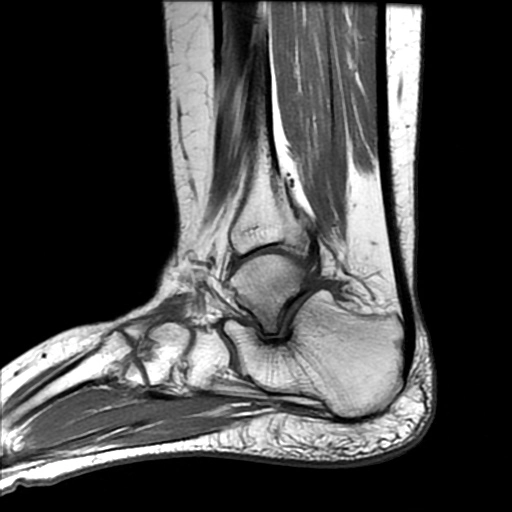 Hội chứng chèn ép sau ngoài bàn chân ngoài khớp (Extra-articular lateral hindfoot impingement syndrome)