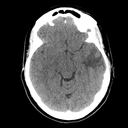 U nhú thần kinh đệm (Papillary glioneuronal tumors - PGNT)