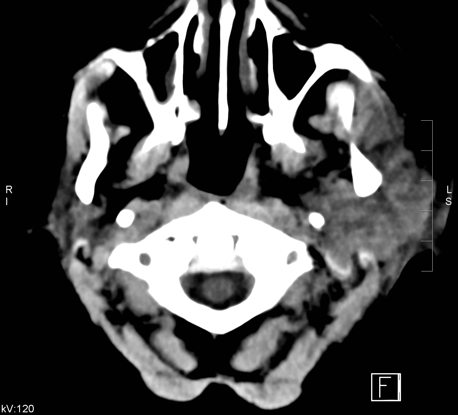 Viêm hoại tử tai ngoài  (Necrotizing otitis externa - NOE)