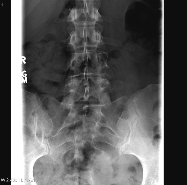 Sarcoma sụn tế bào sáng (Clear cell chondrosarcoma)