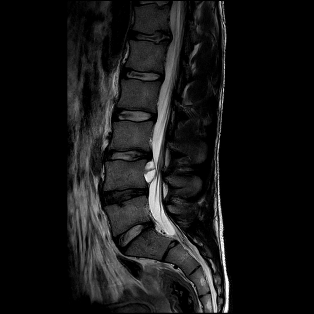 Nang đĩa đệm (Discal cyst)