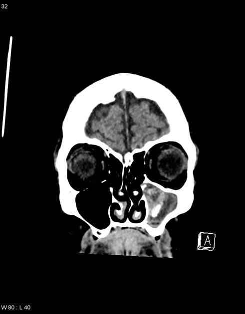 U nấm xoang (Paranasal sinuses mycetomas)