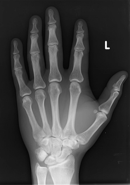 Gãy xương thê (Trapezoid fracture)