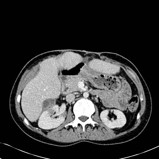 Áp xe thận (Renal abscess)