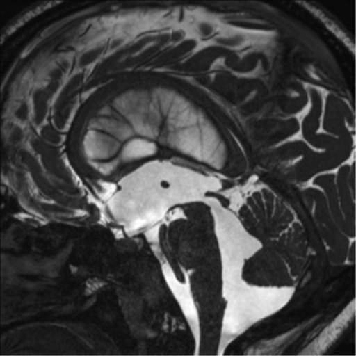 Não úng thủy tắc nghẽn ngoài não thất (EVOH - Extraventricular Obstructive Hydrocephalus)