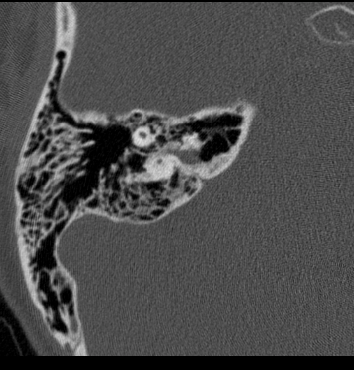 Bất sản ốc tai (Cochlear aplasia)