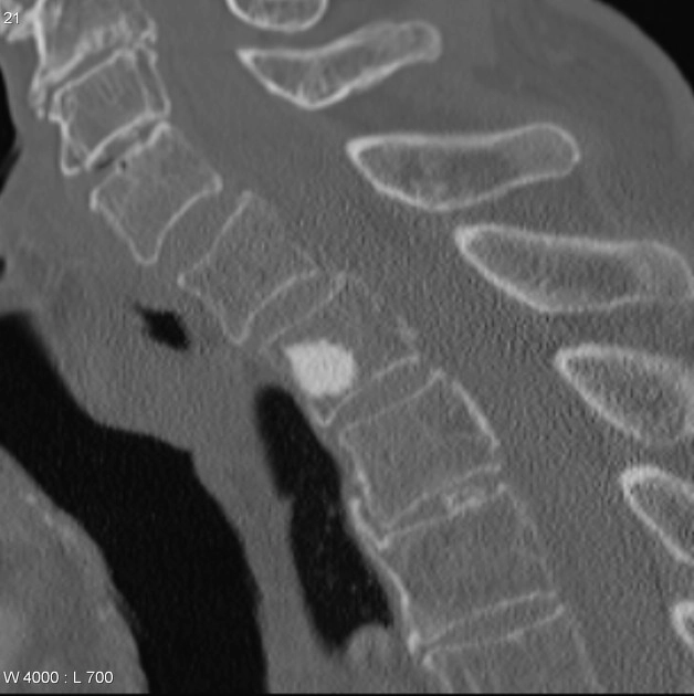 Các khối u nguyên phát thân sống (Primary bone tumors of the spine)