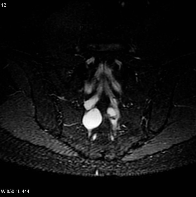 Nang Tarlov (Tarlov cyst)