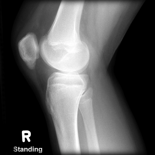 Bệnh Sinding-Larsen-Johansson (SLJ)