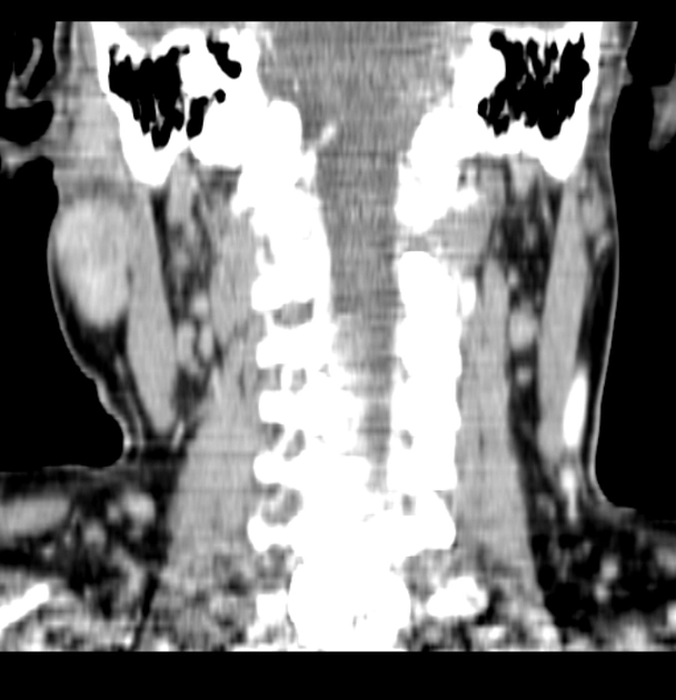 Bệnh Kimura (Kimura disease)