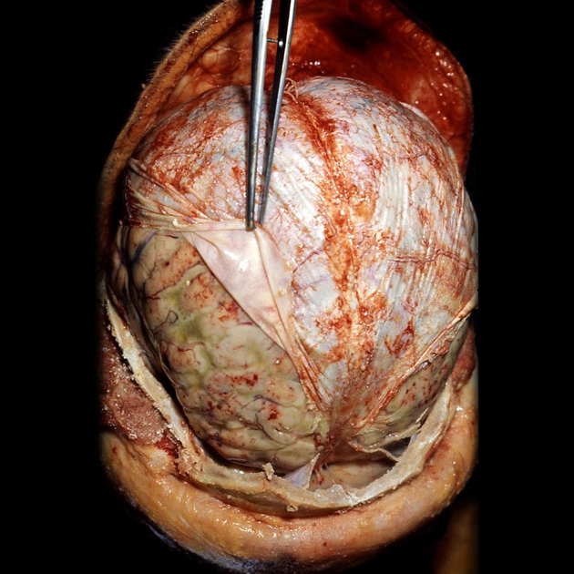 Viêm màng não (Leptomeningitis)
