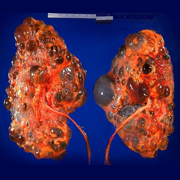 Bệnh thận đa nang di truyền trội (Autosomal Dominant Polycystic Kidney Disease - ADPKD)