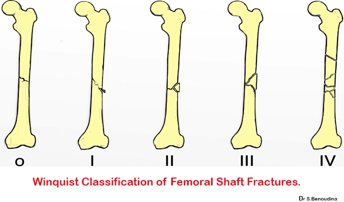 Gãy thân xương đùi (Femoral Shaft Fracture)