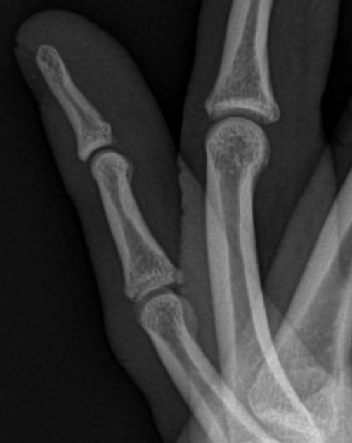 Gãy bong ở mặt lòng tay (Volar plate avulsion injury)