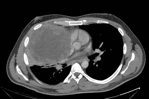 U túi noãn hoàng trung thất (Mediastinal yolk sac tumor)/U tế bào mầm không phải Seminoma (Nonseminomatous germ cell tumor - NSGCT)