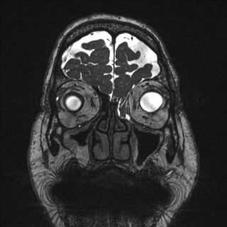 Thoát vị não màng não ra mũi (Frontoethmoidal encephaloceles)