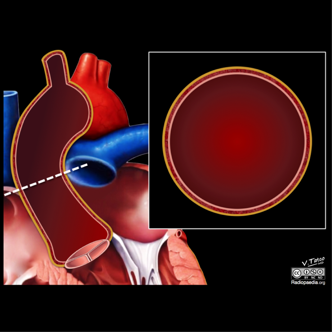Tụ máu trong thành động mạch chủ (Aortic intramural hematoma - IMH)