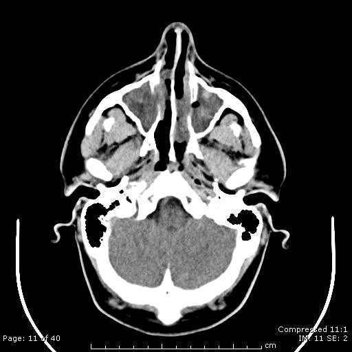 Polyp mũi xoang (Sinonasal polyposis)