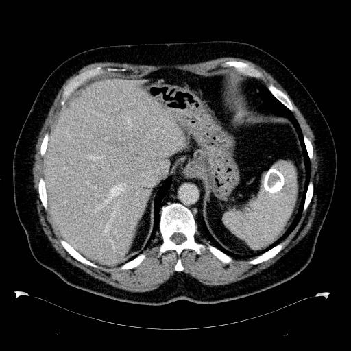 Vôi hóa lách (Splenic calcification)