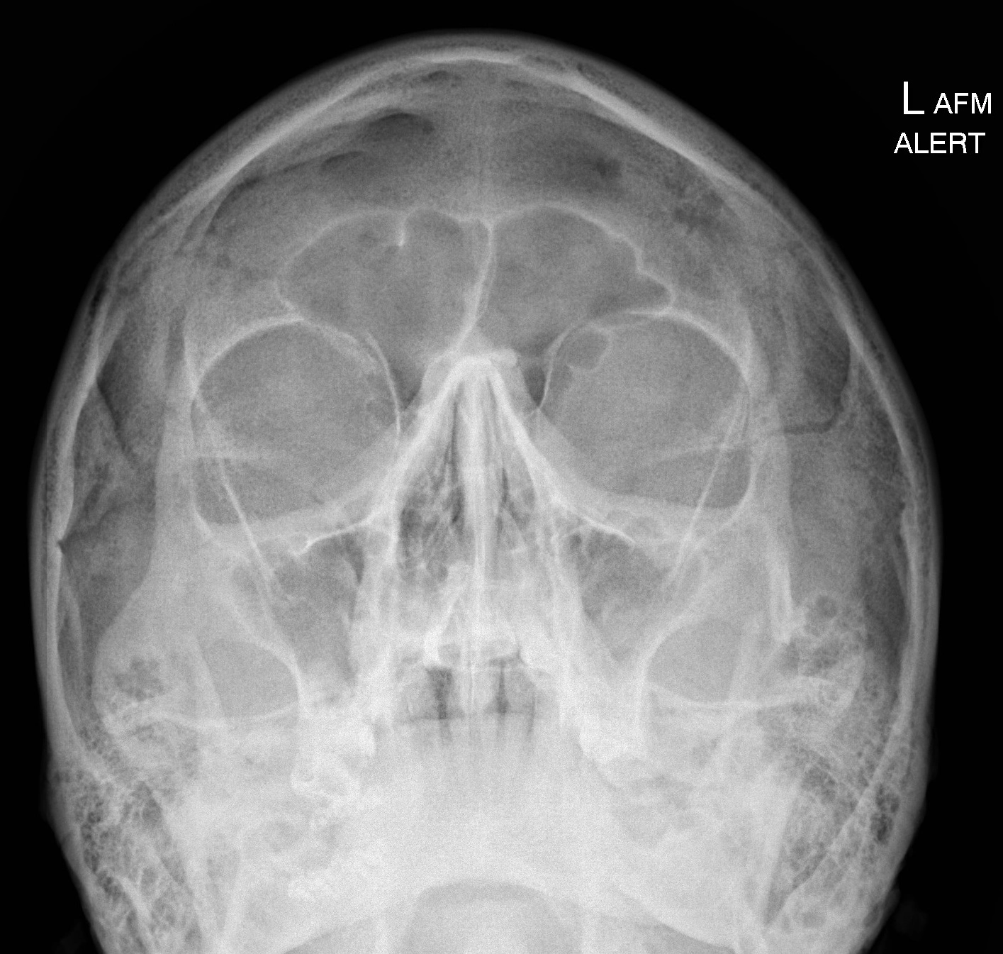 Gãy cung gò má (Zygomatic arch fractures)