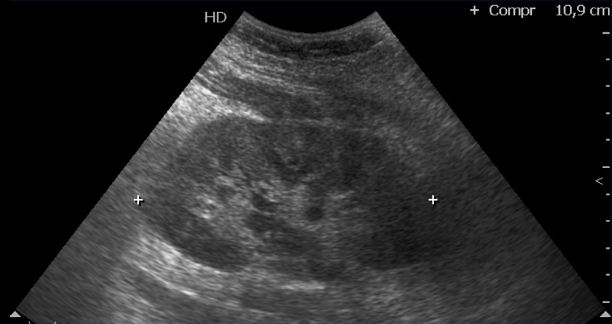 Rò động-tĩnh mạch thận (Renal Arteriovenous Fistula - AVF)