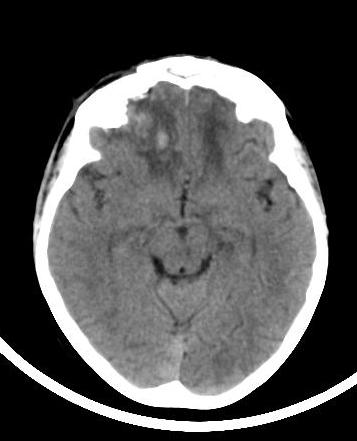 Gãy hốc mắt "blow-in" (Orbital blow-in fractures)