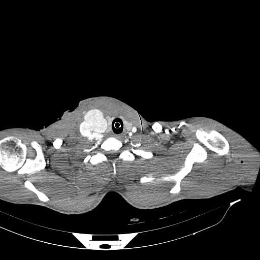 Giả phình động mạch cảnh (Carotid artery pseudoaneurysm)